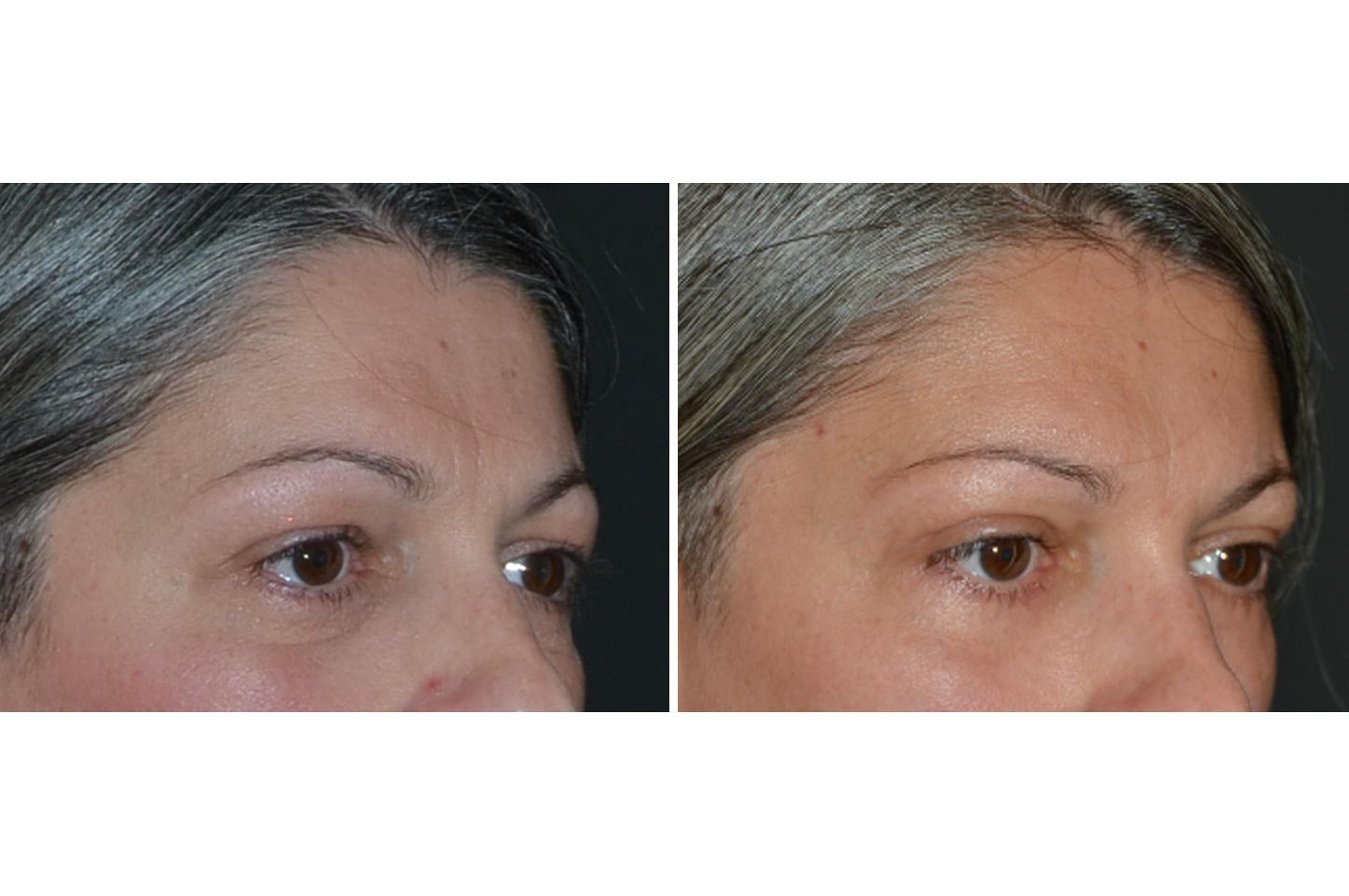 brow-lift-a1.jpg