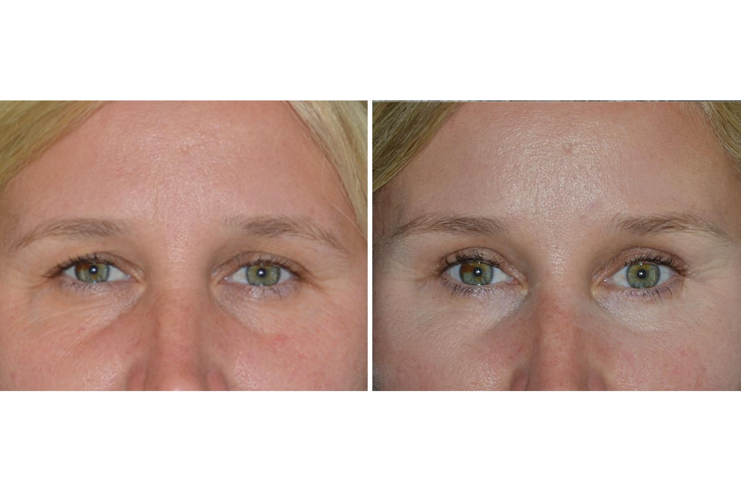 brow-lift-b1.jpg