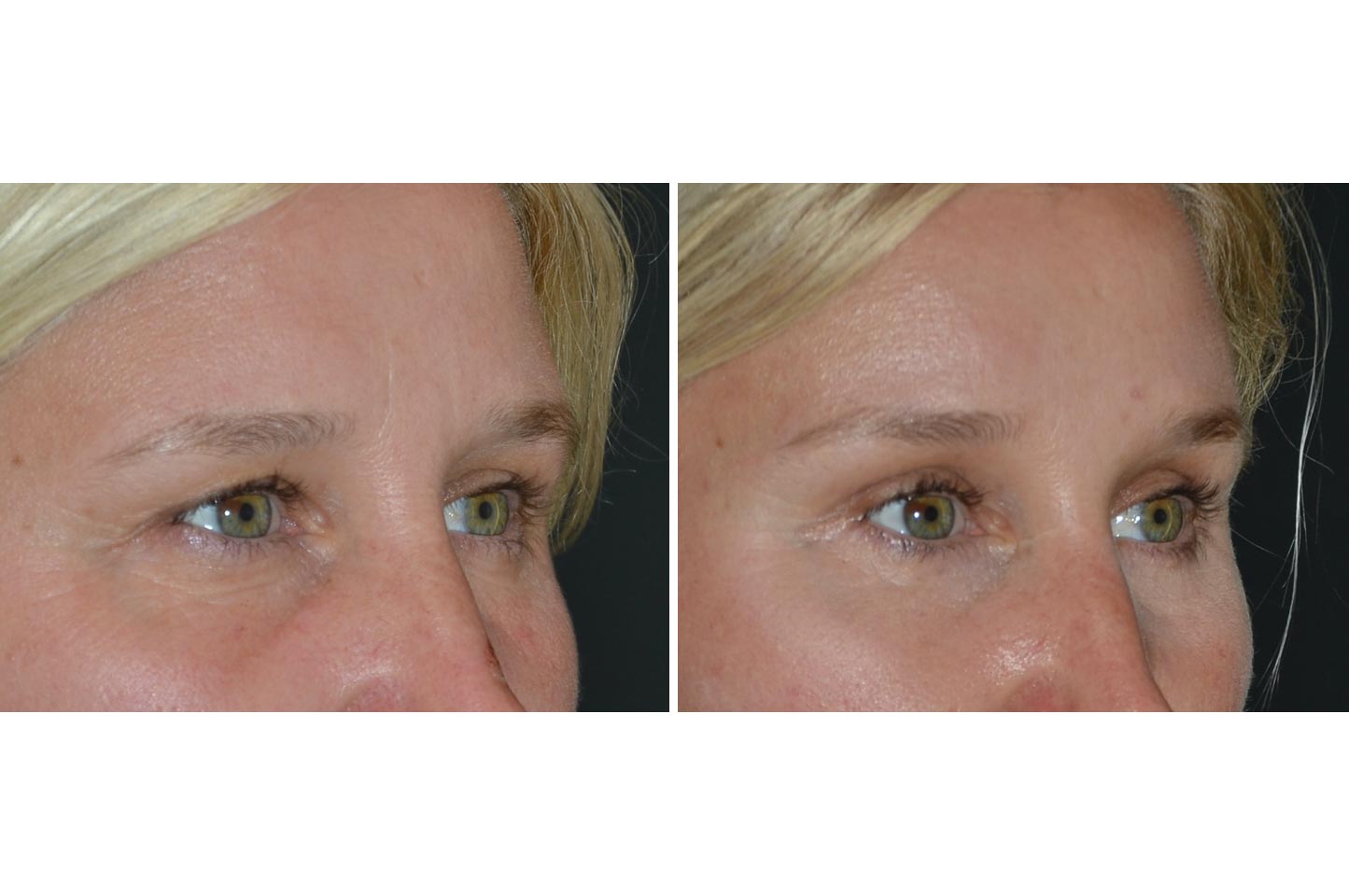 brow-lift-b3.jpg