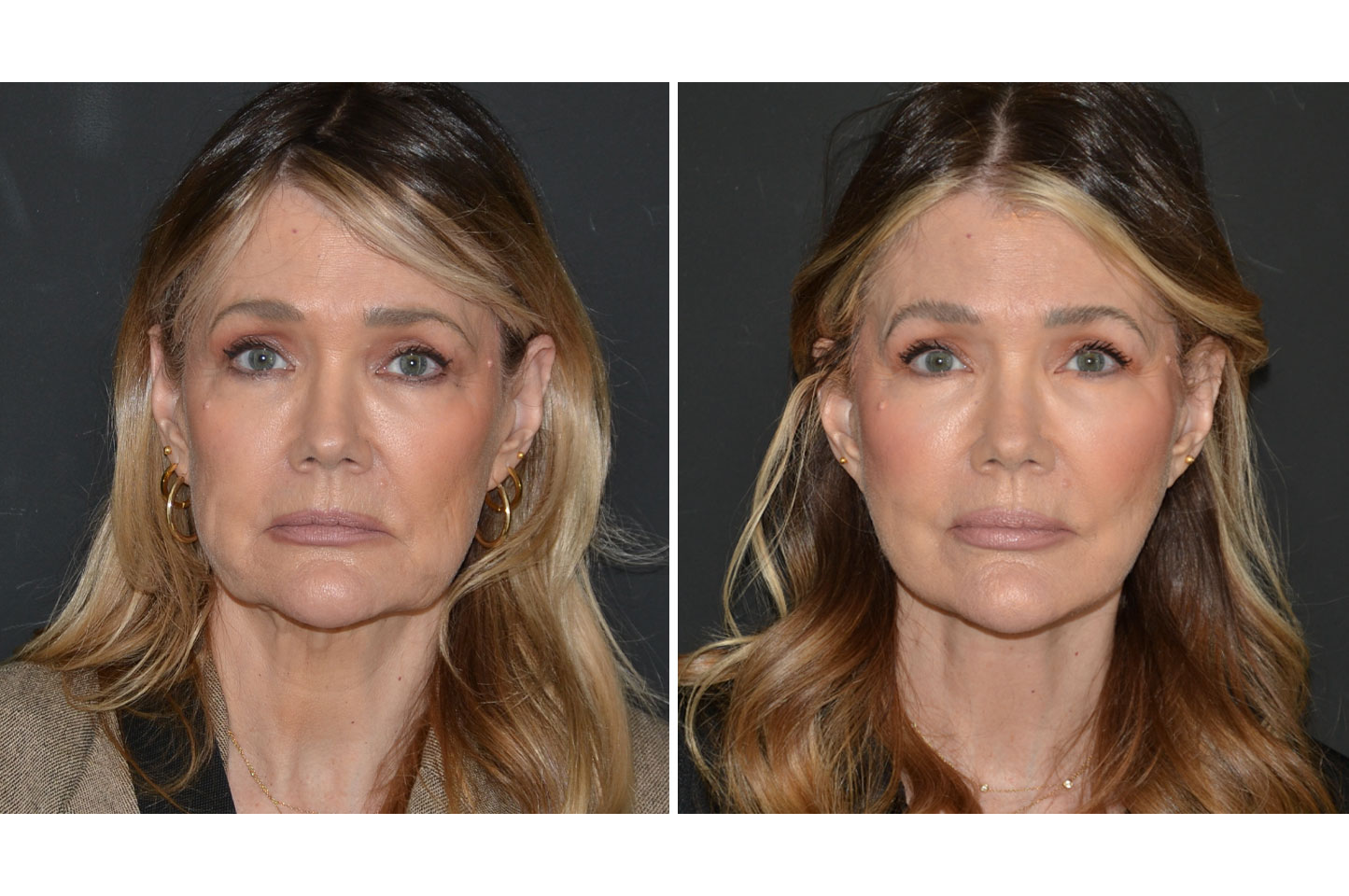 deep-plane-facelift-a1.jpg