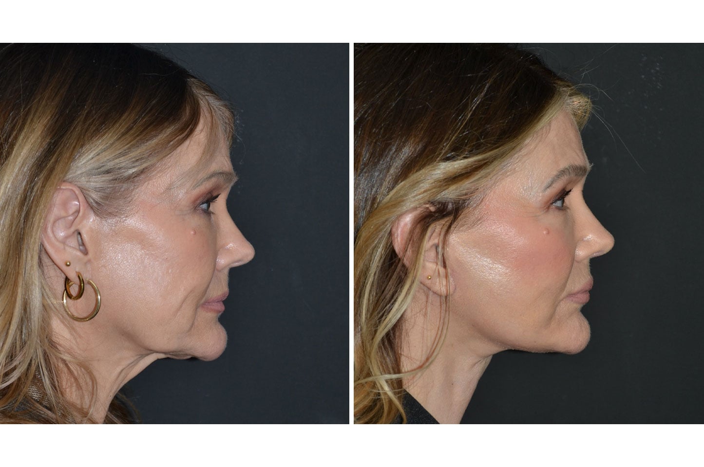 deep-plane-facelift-a2.jpg
