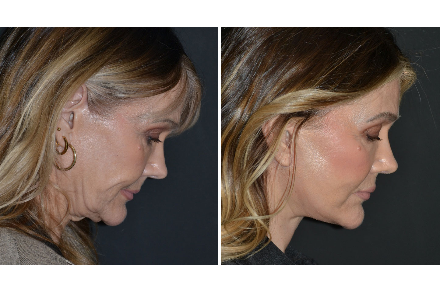 deep-plane-facelift-a3.jpg