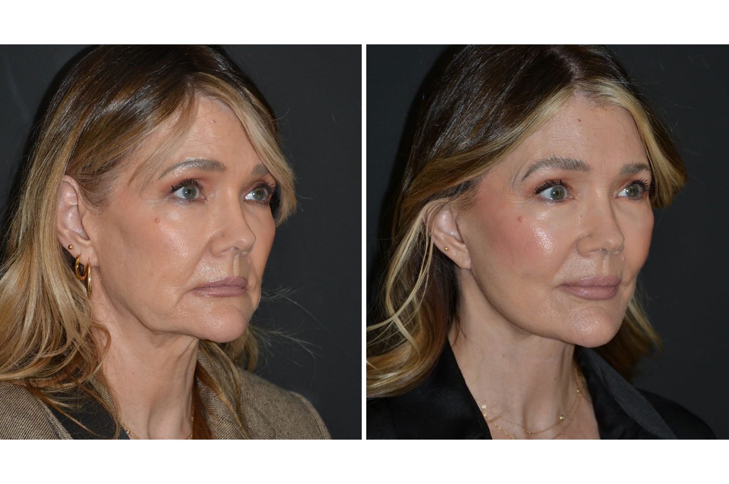 deep-plane-facelift-a4.jpg