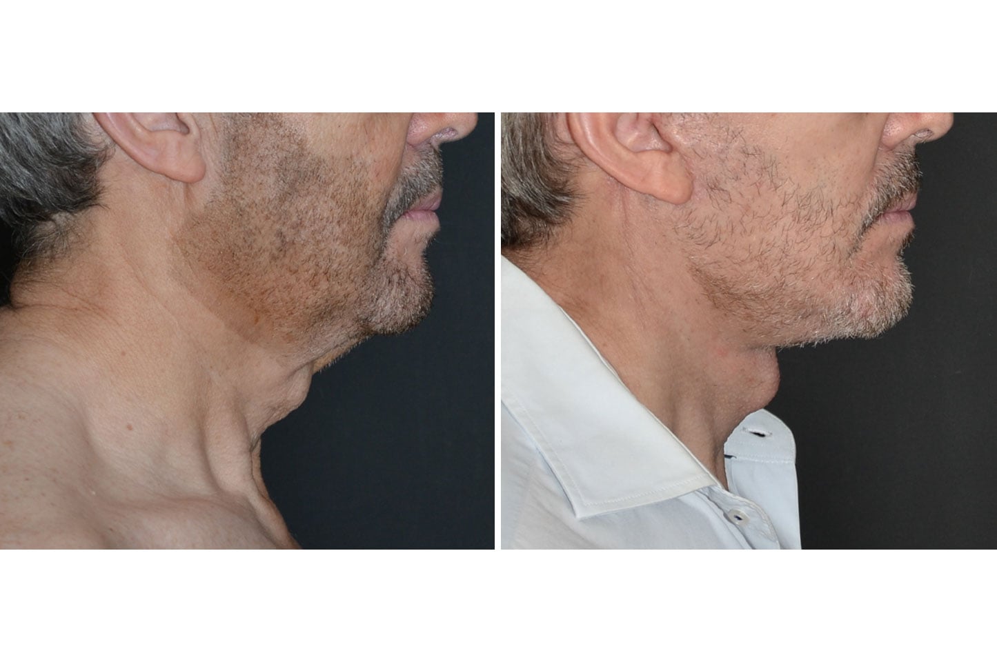 deep-plane-facelift-b1.jpg