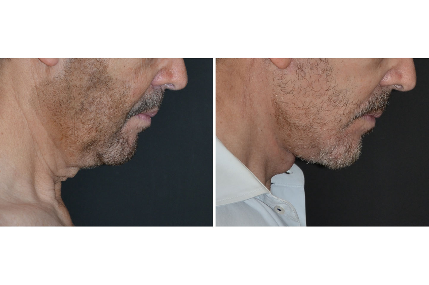 deep-plane-facelift-b2.jpg