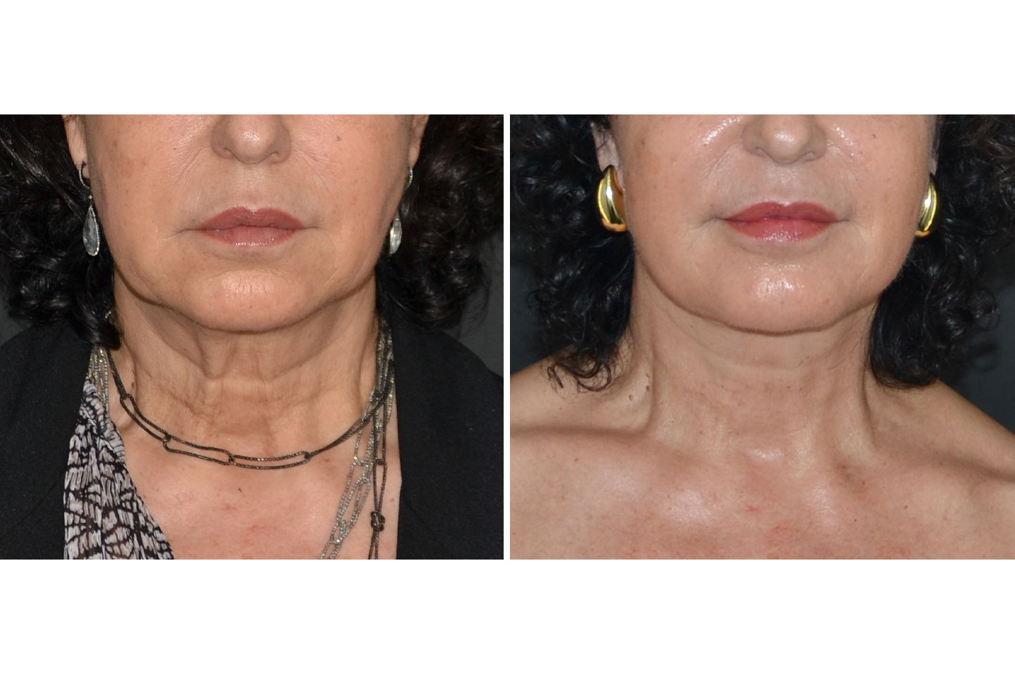 deep-plane-facelift-c1.jpg