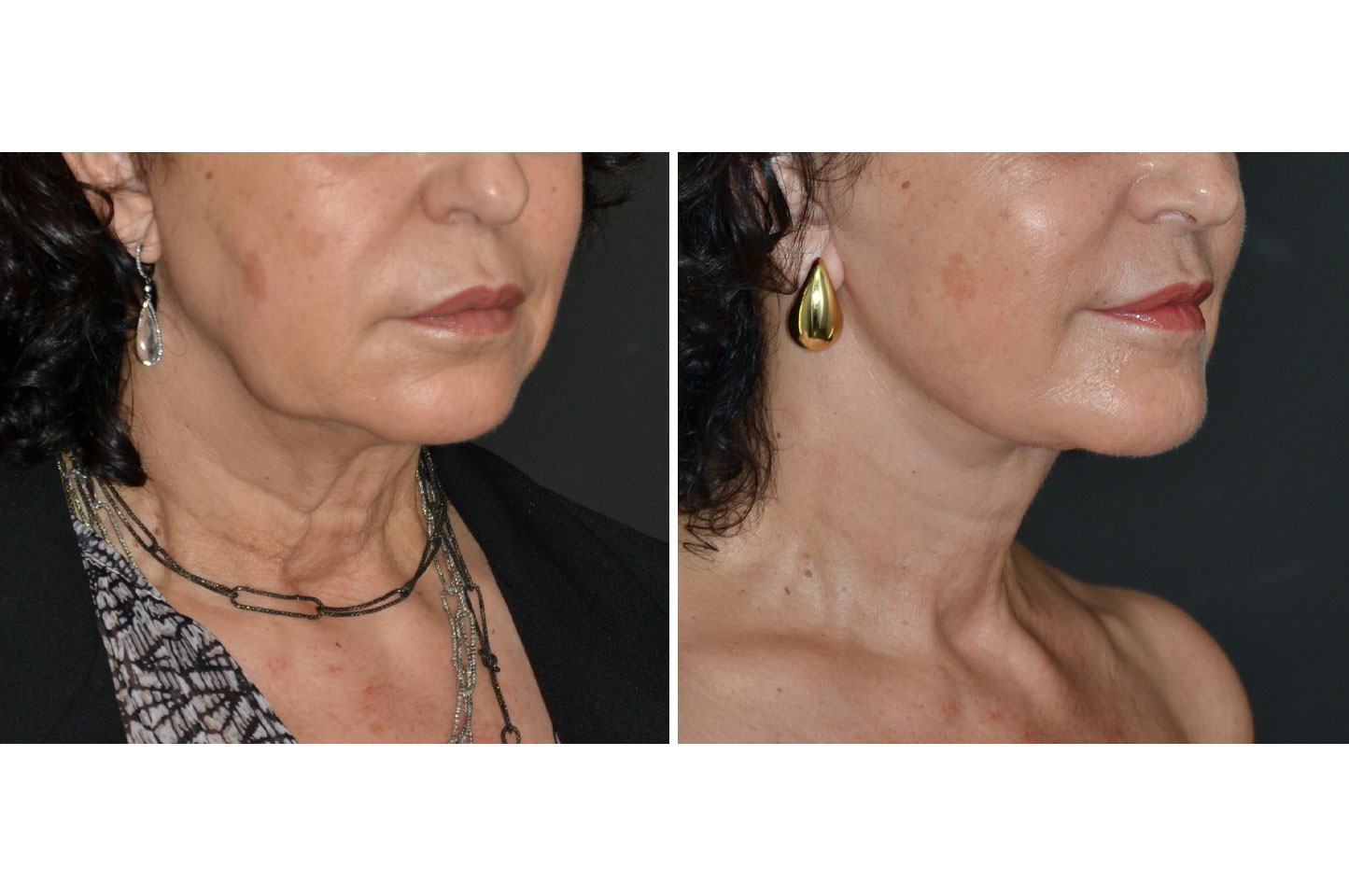 deep-plane-facelift-c2.jpg