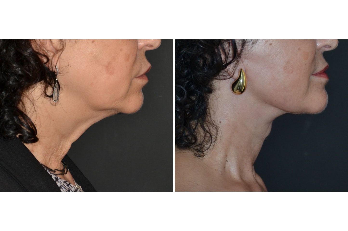 deep-plane-facelift-c3.jpg