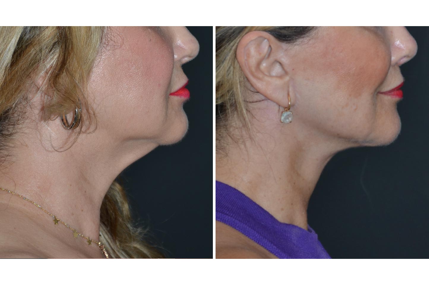 face-neck-a2.jpg