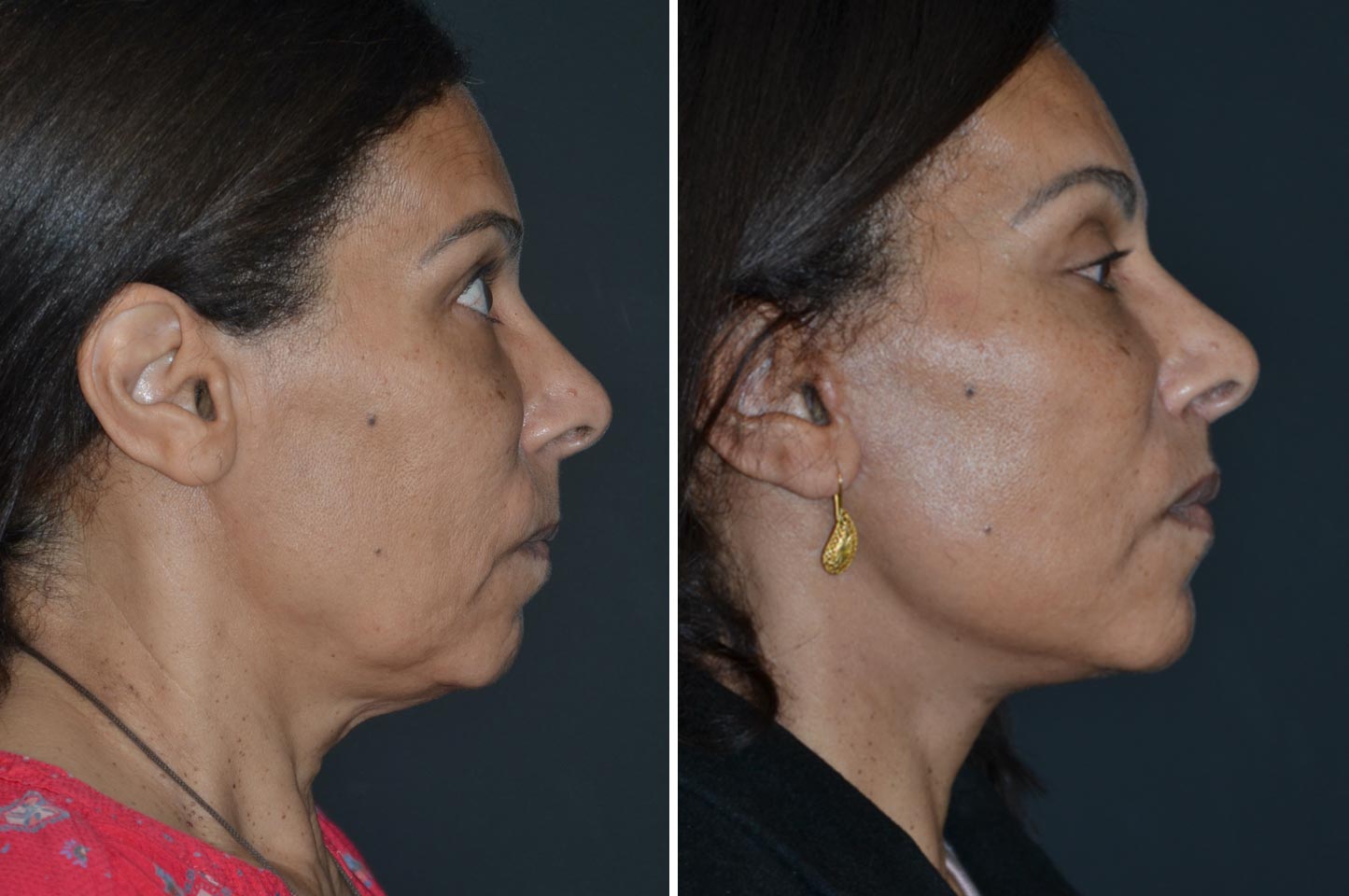 face-neck-b2.jpg