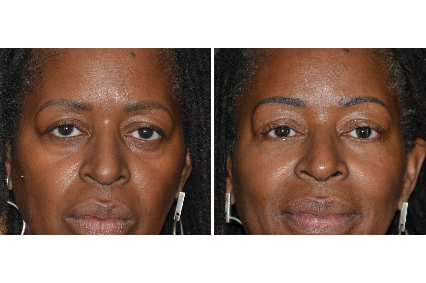 gallery-brow-lift-a12.jpg