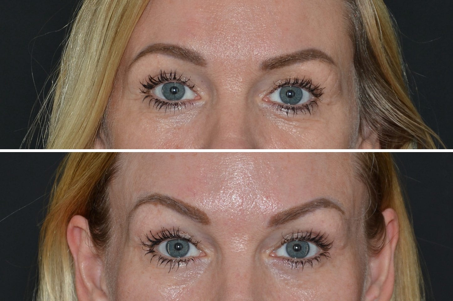 gallery-brow-lift-c1.jpg
