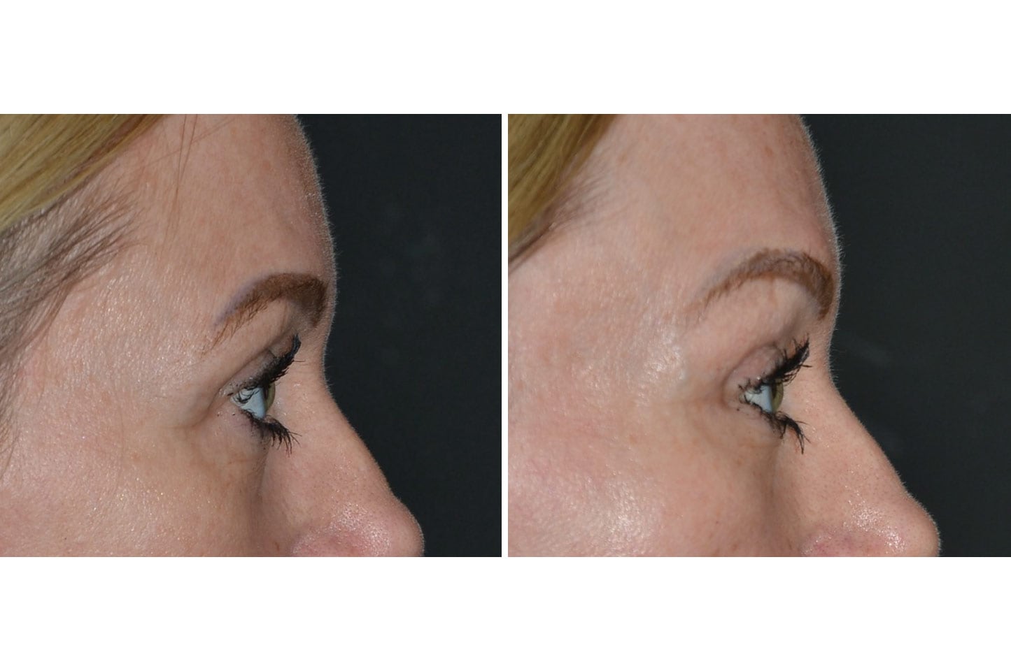 gallery-brow-lift-c2.jpg