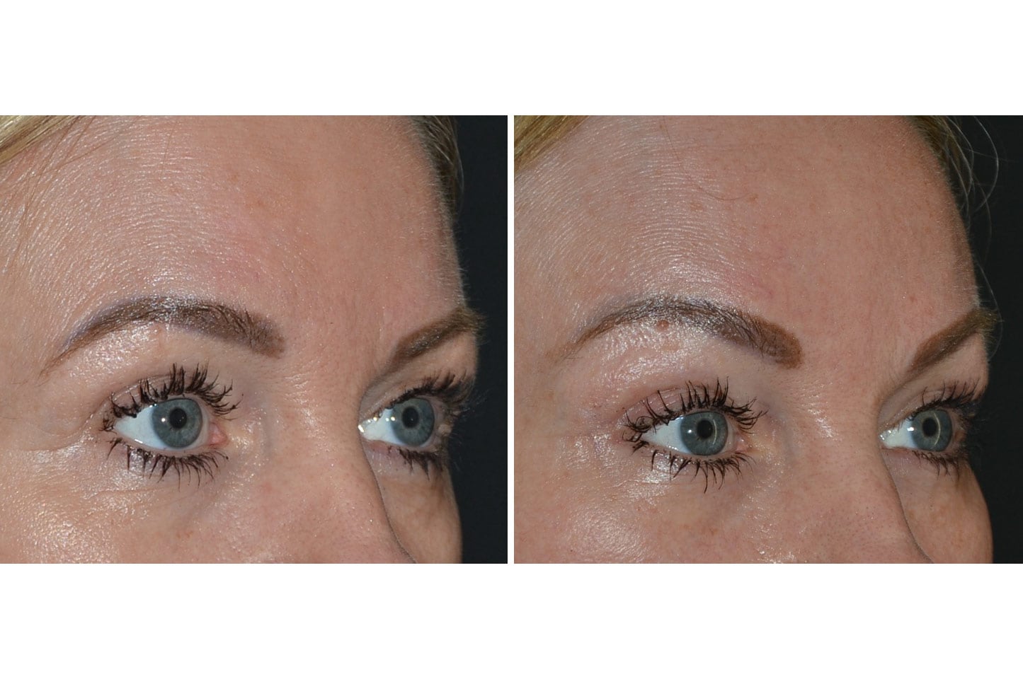 gallery-brow-lift-c3.jpg