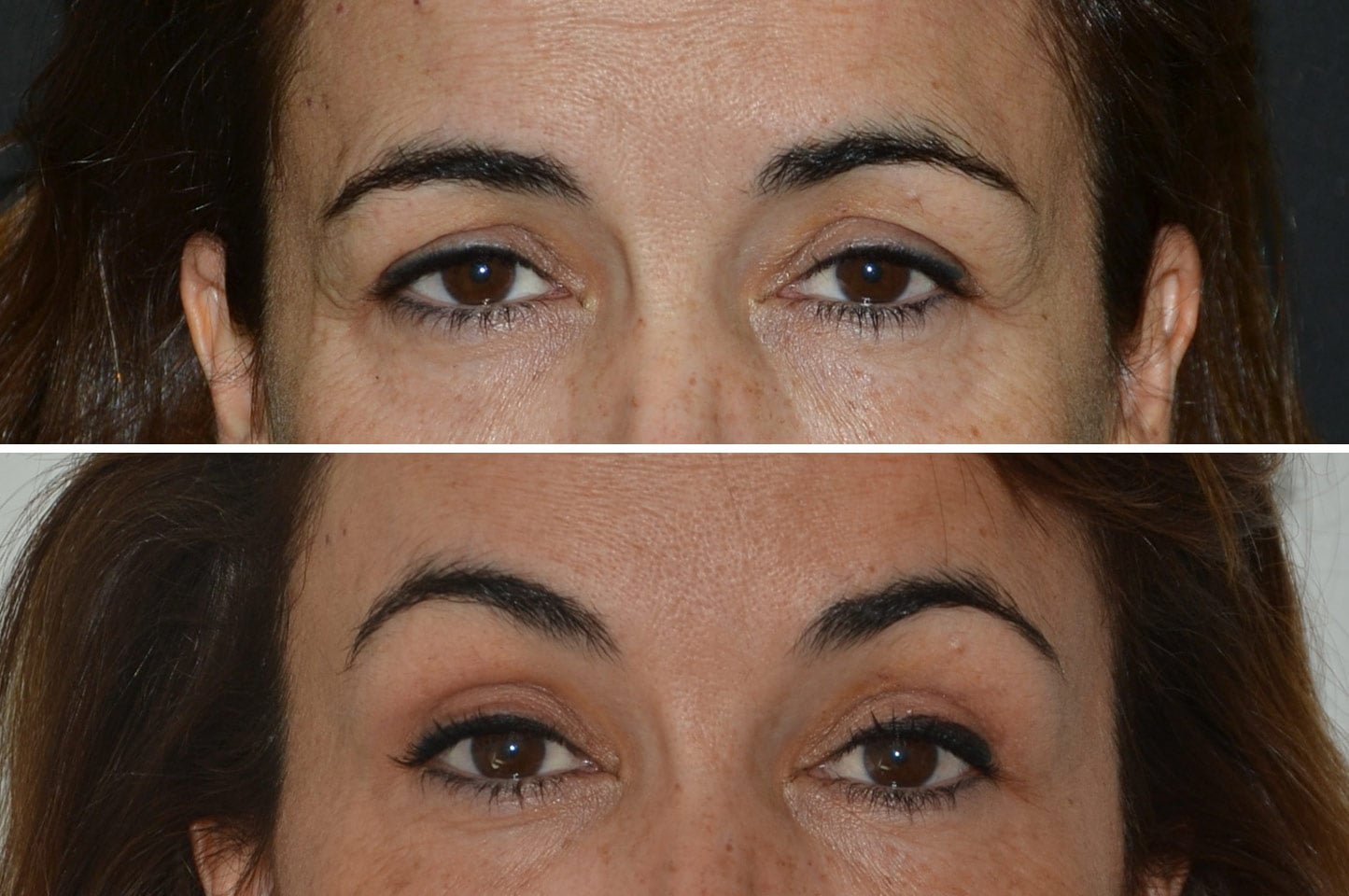 gallery-brow-lift-c4.jpg