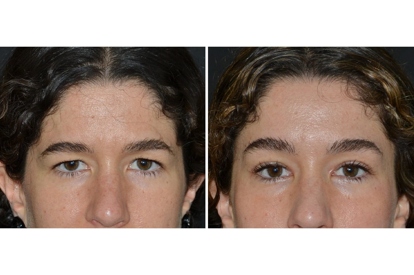 gallery-endoscopic-brow-lift-a1.jpg