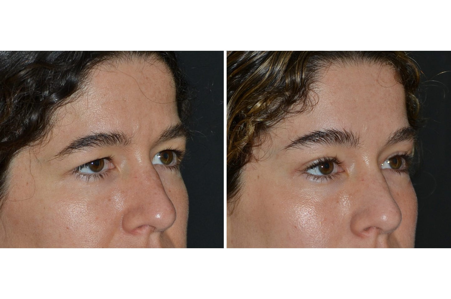 gallery-endoscopic-brow-lift-a2.jpg
