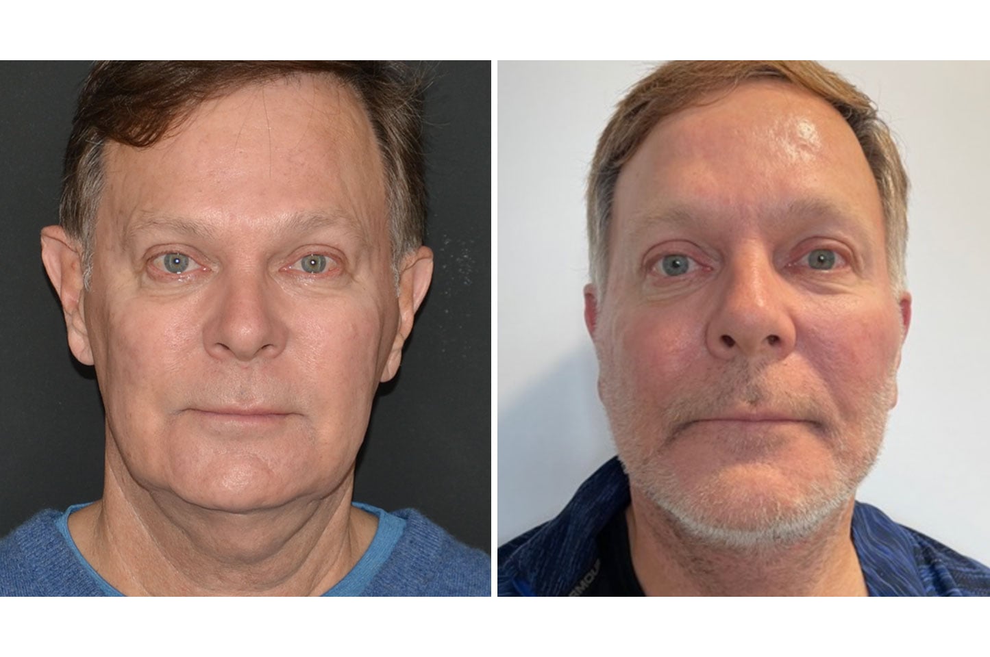 gallery-face-necklift-a2.jpg