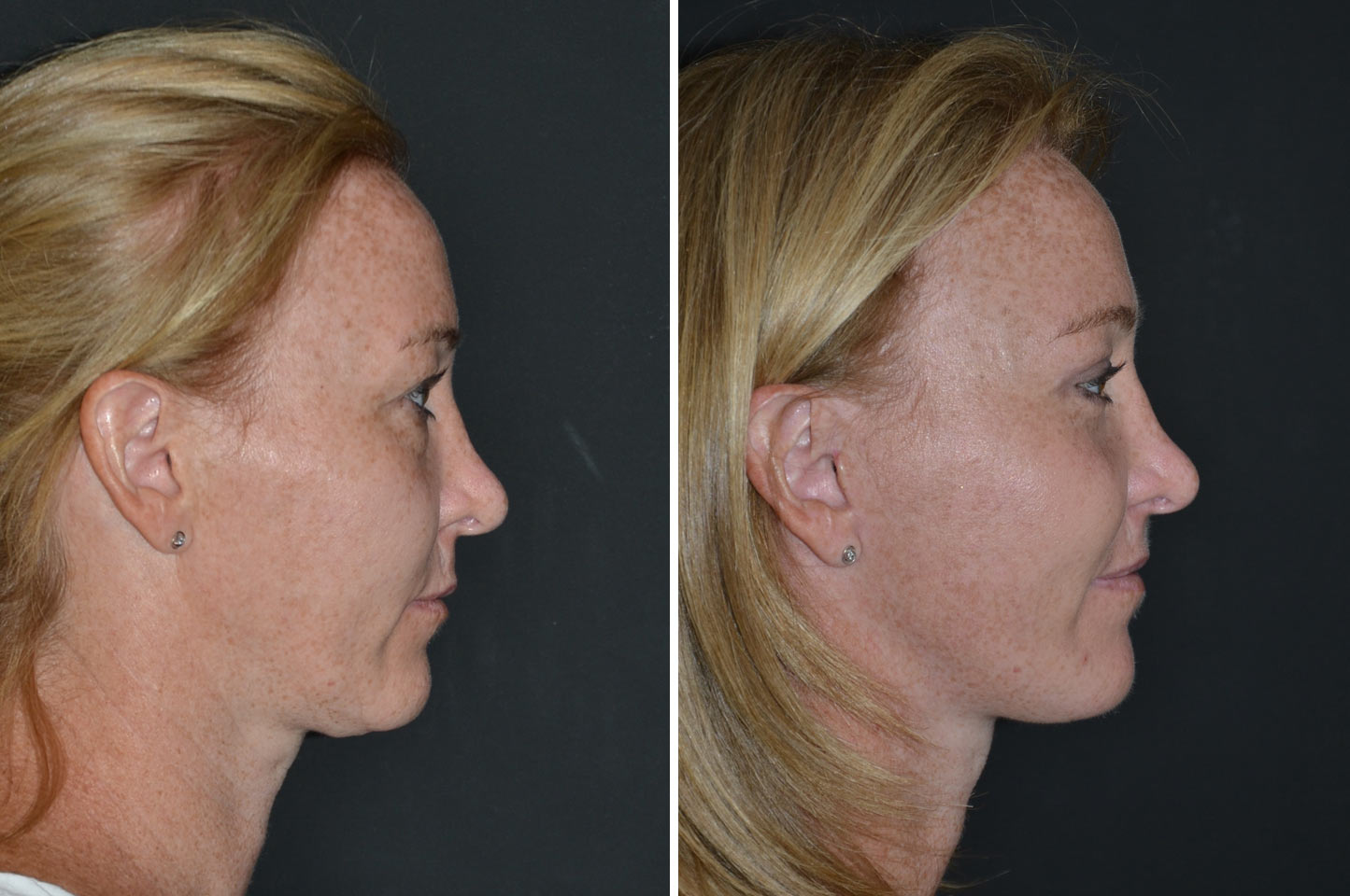 imagn-ba-deep-plane-facelift-a1.jpg