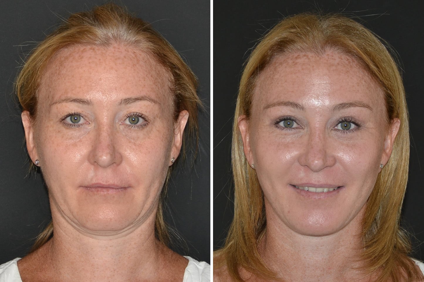 imagn-ba-deep-plane-facelift-a2.jpg