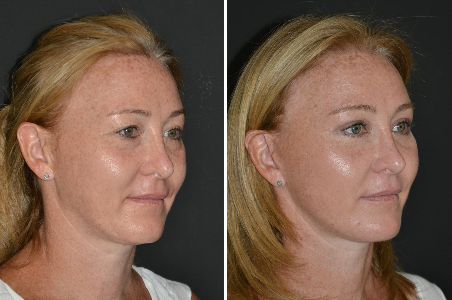 imagn-ba-deep-plane-facelift-a3.jpg