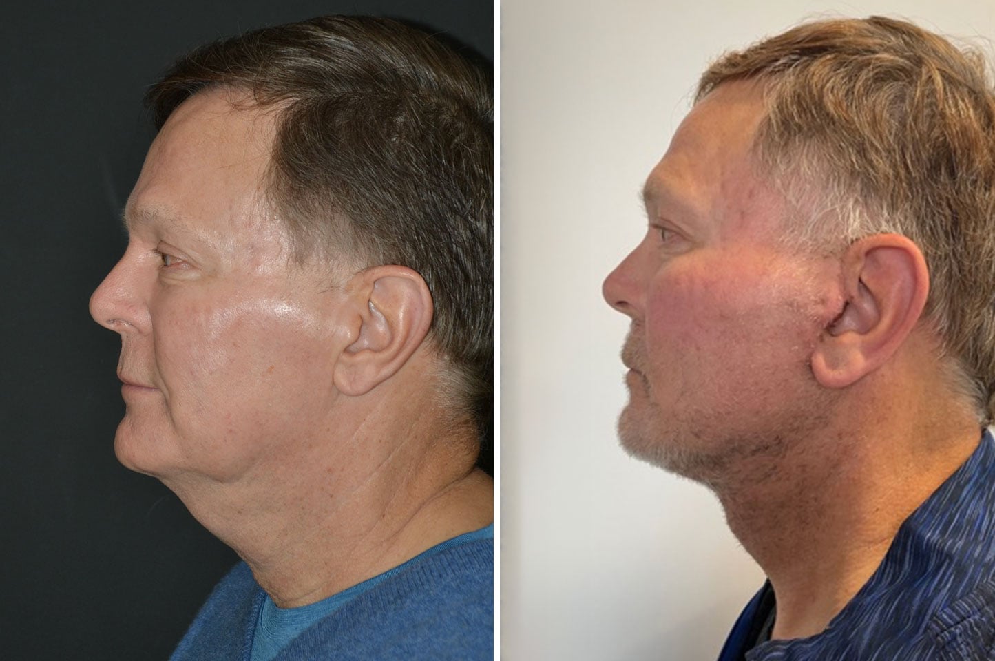 imagn-ba-neck-facelift-a1.jpg