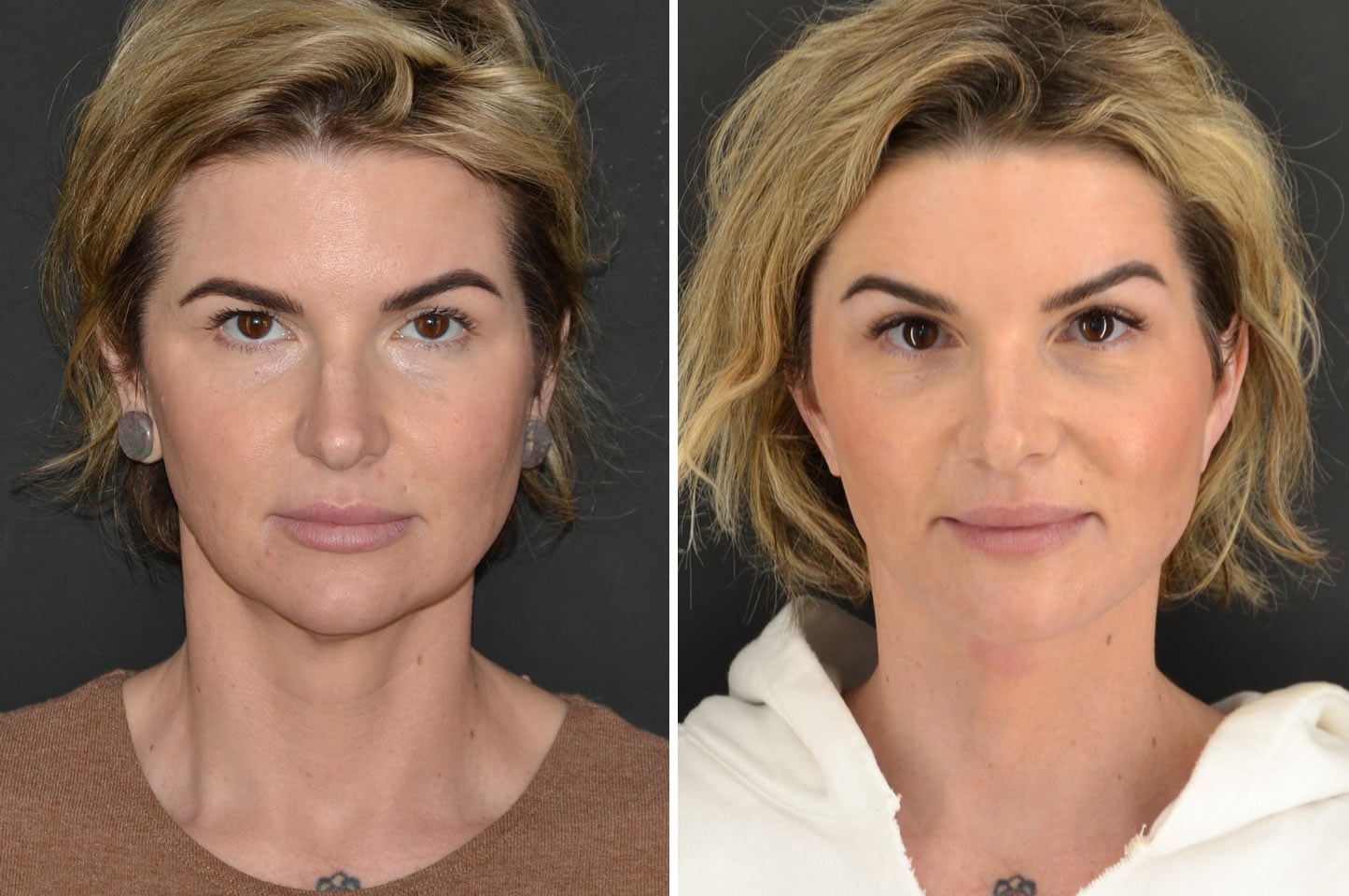 imagn-ba-neck-facelift-a2.jpg