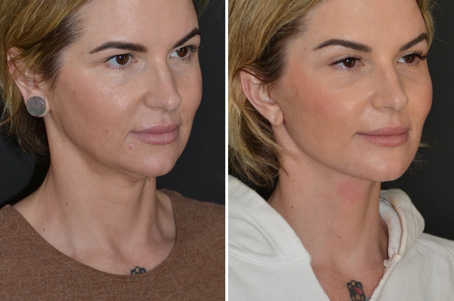 imagn-ba-neck-facelift-a3.jpg