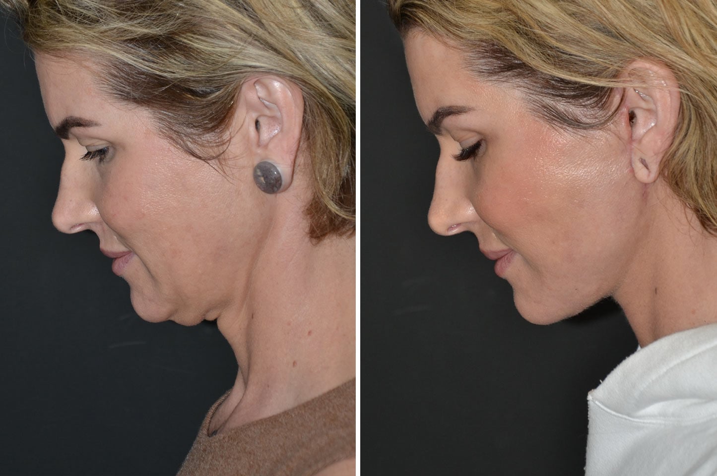 imagn-ba-neck-facelift-a4.jpg