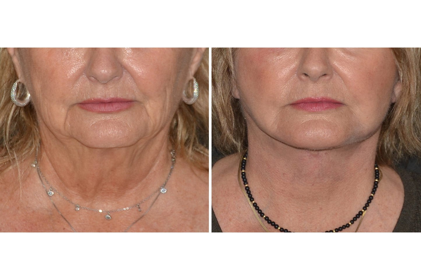 imagn-ba-neck-facelift-b1.jpg