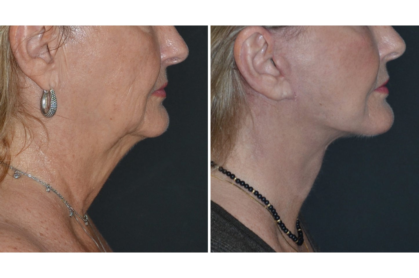 imagn-ba-neck-facelift-b2.jpg
