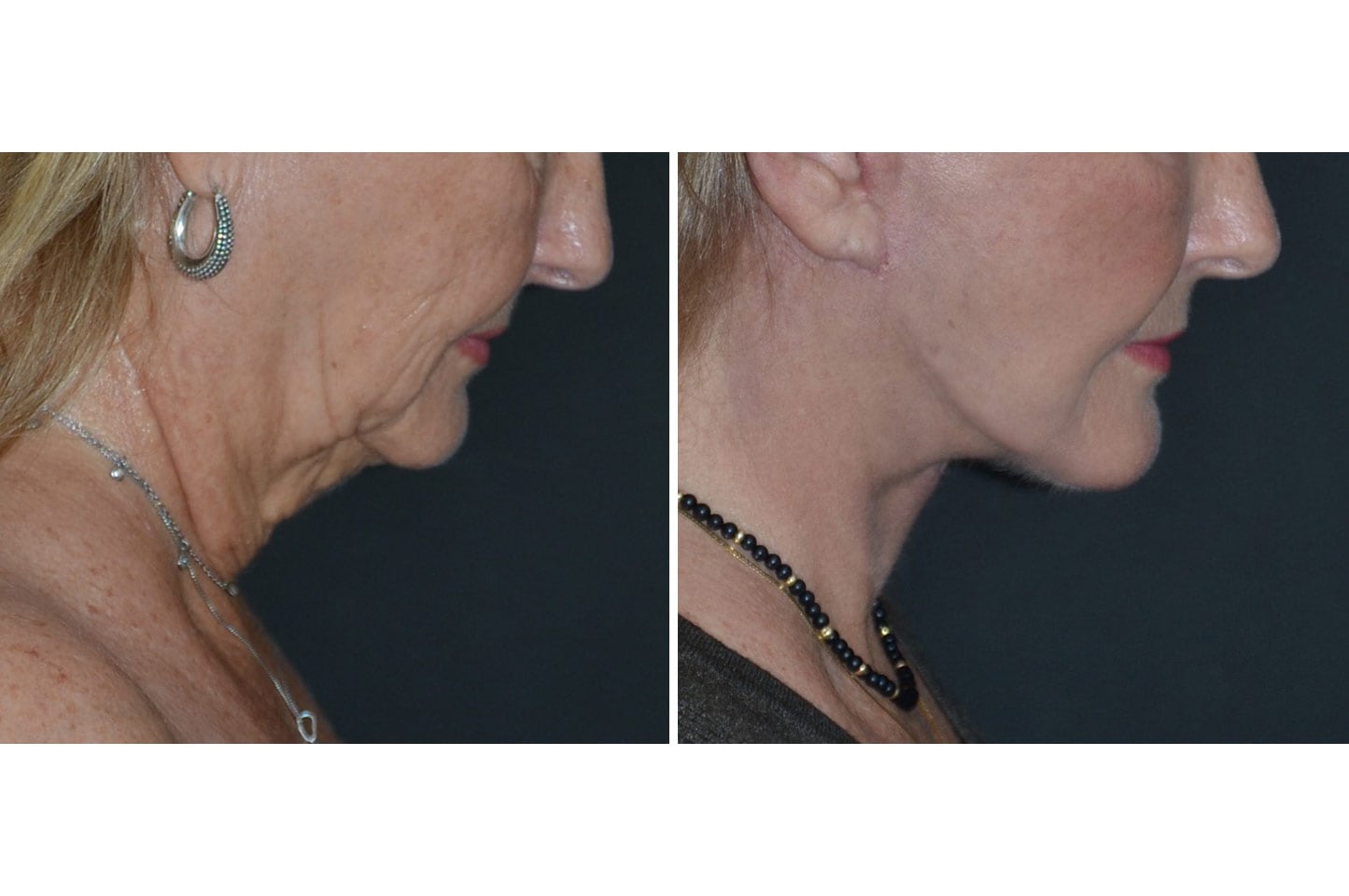 imagn-ba-neck-facelift-b3.jpg