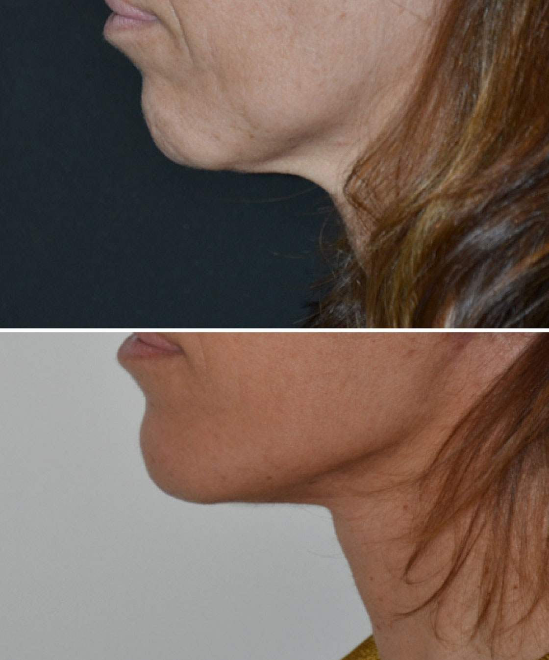 imagn-gallery-neck-lift-a.jpg